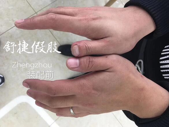 假肢價(jià)格