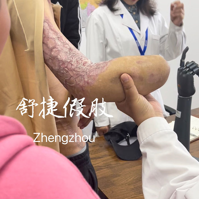 前臂假肢，智能手.jpg